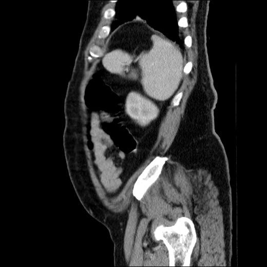 Obstructing ureteric calculus (Radiopaedia 49281-54373 C 20).jpg