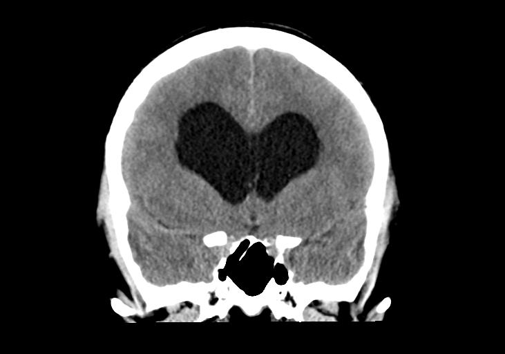 File:Obstructive hydrocephalus (Radiopaedia 30453-31119 Coronal non-contrast 15).jpg