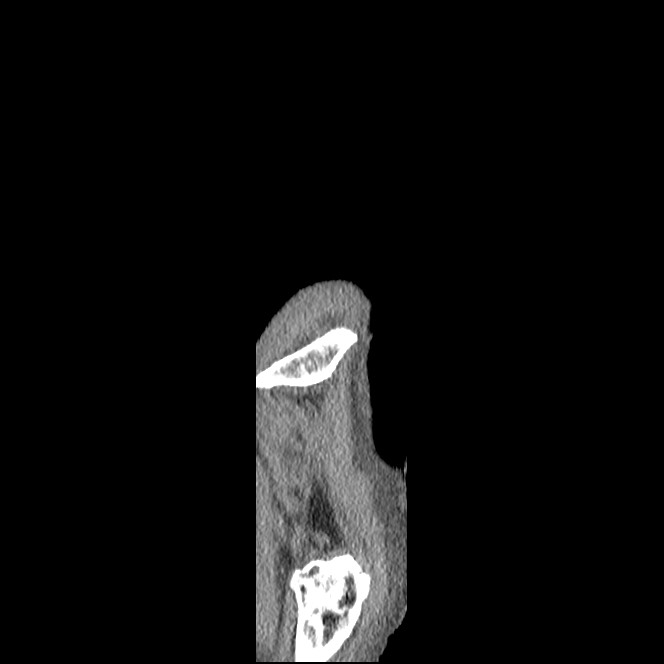 Obturator hernia causing small bowel obstruction (Radiopaedia 65522-74612 C 2).jpg