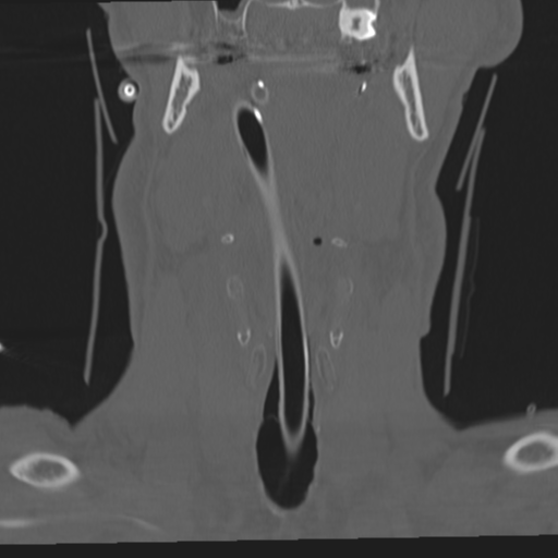 File:Occipital condyle fracture (Radiopaedia 33467-34517 Coronal bone window 2).png