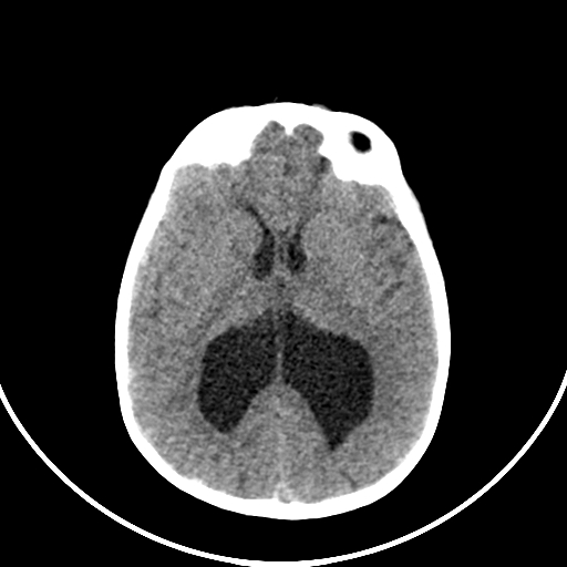 Occipital encephalocele (Radiopaedia 87339-103636 Axial non-contrast 46).jpg