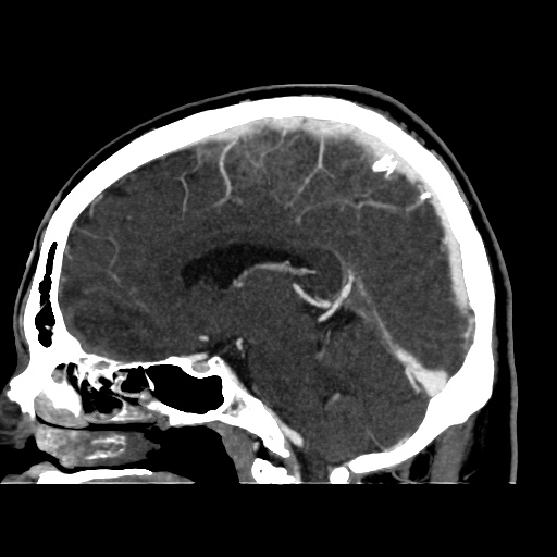 Occipital extradural hematoma simulating venous sinus thrombosis (Radiopaedia 46514-50964 D 42).jpg