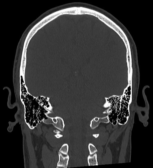 Occipital spur and Currarino type A atlas anomaly (Radiopaedia 87027-103285 Coronal bone window 97).jpg
