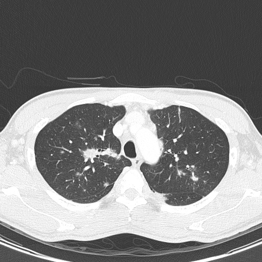 AIDS-related Kaposi sarcoma (Radiopaedia 85247-100811 Axial lung window 41).jpg
