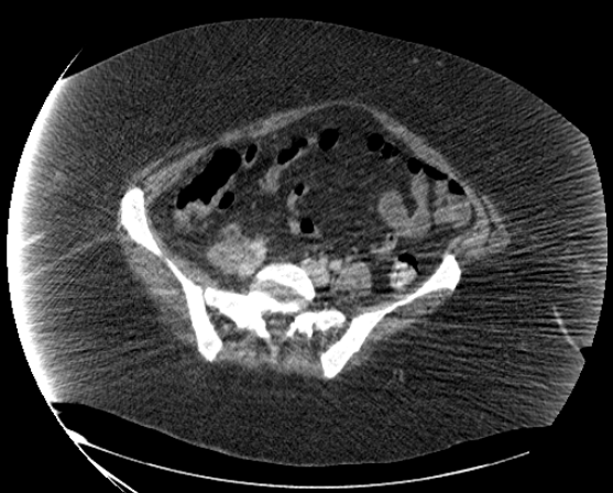 File:Abdominal abscess - pre and post percutaneous drainage (Radiopaedia 60209-67816 Axial 70).png