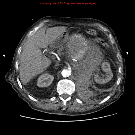 File:Abdominal aortic aneurysm- extremely large, ruptured (Radiopaedia 19882-19921 Axial C+ arterial phase 19).jpg