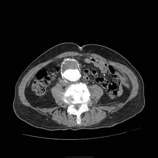 Abdominal aortic aneurysm (Radiopaedia 13341-13340 Axial C+ arterial phase 135).jpg