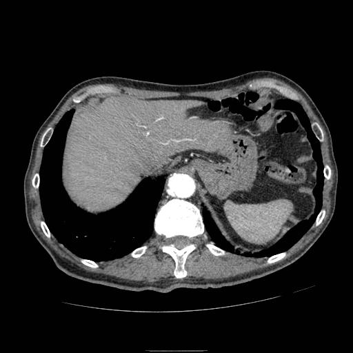 Abdominal aortic aneurysm (Radiopaedia 13341-13340 Axial C+ arterial phase 27).jpg