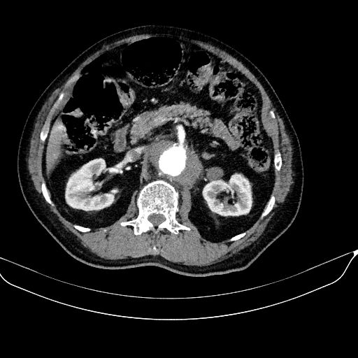 Abdominal aortic aneurysm (Radiopaedia 67117-76452 Axial C+ arterial phase 53).jpg