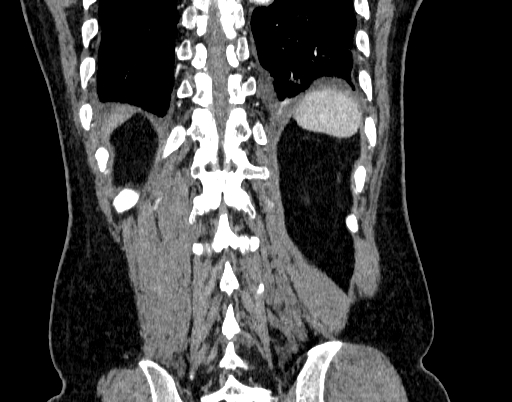 File:Abdominal aortic aneurysm (Radiopaedia 67117-76452 Coronal C+ arterial phase 95).jpg