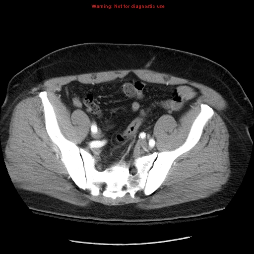 Abdominal aortic aneurysm (Radiopaedia 8190-9038 Axial C+ arterial phase 66).jpg