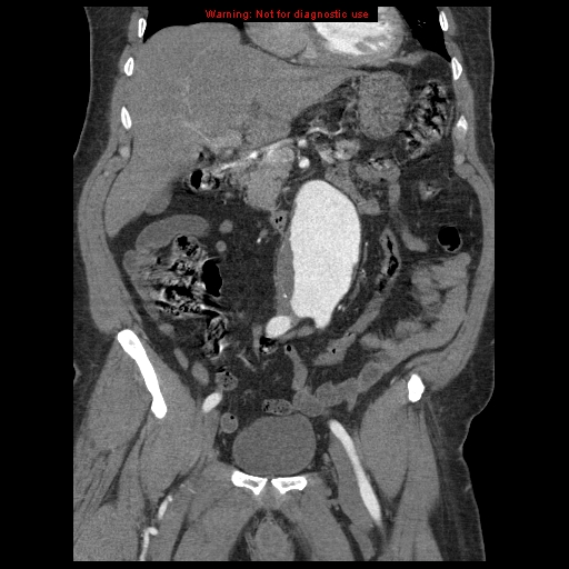 Abdominal aortic aneurysm (Radiopaedia 8190-9038 Coronal C+ arterial phase 50).jpg