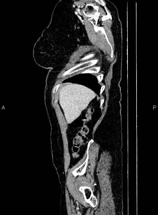 Abdominal aortic aneurysm (Radiopaedia 85063-100606 Sagittal C+ arterial phase 7).jpg