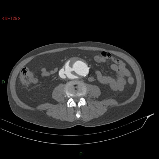 File:Abdominal aortic aneurysm rupture with aortocaval fistula (Radiopaedia 14897-14841 Axial C+ arterial phase 125).jpg