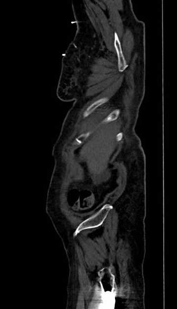 Abdominal aortic aneurysm with thrombus fissuration (Radiopaedia 73192-83919 Sagittal C+ arterial phase 133).jpg