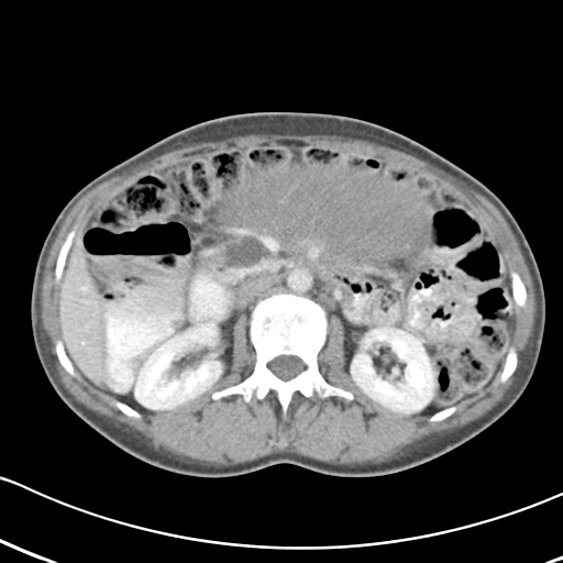 Abdominal desmoid tumor (Radiopaedia 41007-43740 Axial C+ portal venous phase 24).png