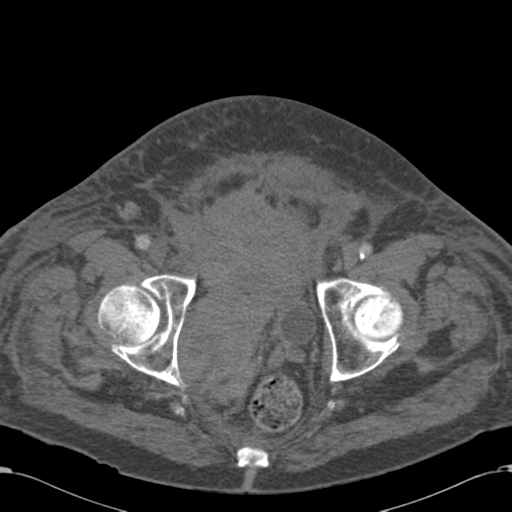 Abdominal hematoma (Radiopaedia 33614-34715 Axial C+ portal venous phase 123).png