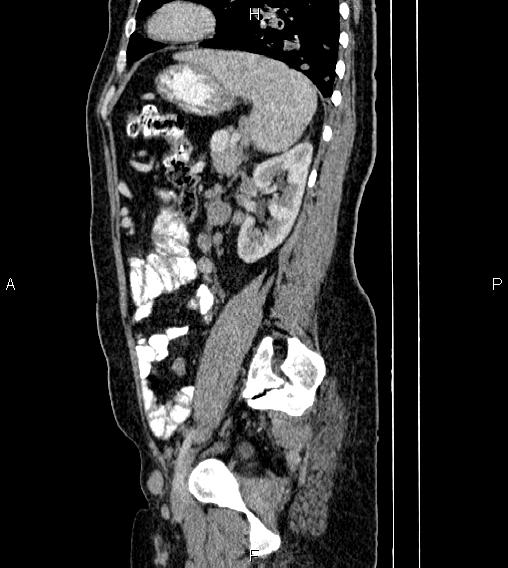 Abdominal lymphoma with sandwich sign (Radiopaedia 84378-99704 Sagittal C+ portal venous phase 66).jpg