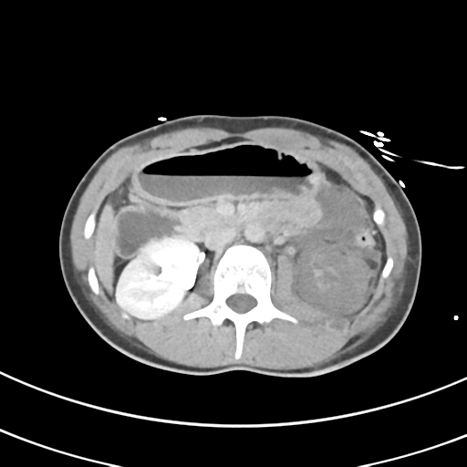 File:Abdominal multi-trauma - devascularised kidney and liver, spleen and pancreatic lacerations (Radiopaedia 34984-36486 Axial C+ delayed 32).png