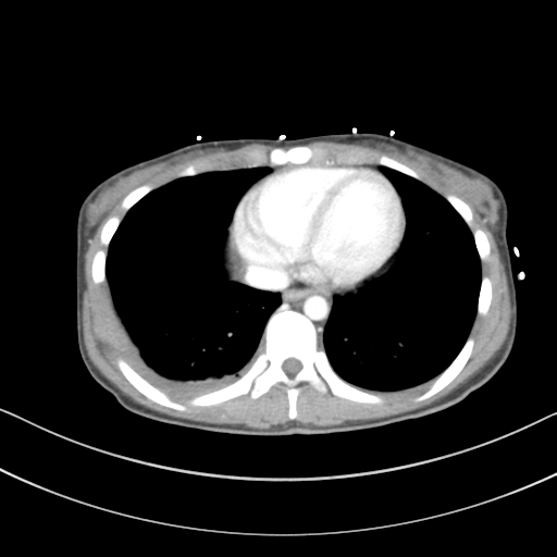 File:Abdominal multi-trauma - devascularised kidney and liver, spleen and pancreatic lacerations (Radiopaedia 34984-36486 Axial C+ portal venous phase 4).png