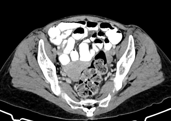 Abdominal wall and retroperitoneal tuberculosis (Radiopaedia 88137-104729 Axial C+ portal venous phase 157).jpg