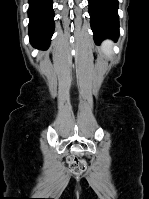 Abdominal wall and retroperitoneal tuberculosis (Radiopaedia 88137-104729 Coronal C+ portal venous phase 91).jpg