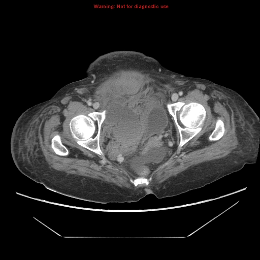 File:Abdominal wall hematoma (Radiopaedia 9427-10112 Axial C+ portal venous phase 101).jpg