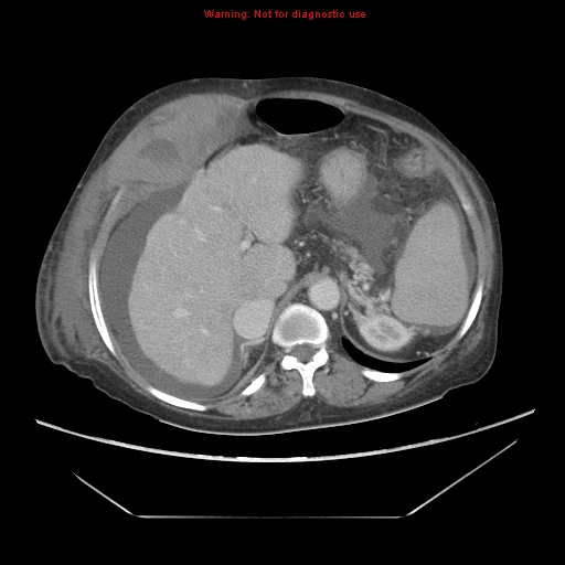 File:Abdominal wall hematoma (Radiopaedia 9427-10112 Axial C+ portal venous phase 29).jpg