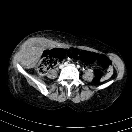 Abdominal wall hematoma with active bleeding (Radiopaedia 83915-99117 Axial C+ portal venous phase 75).jpg