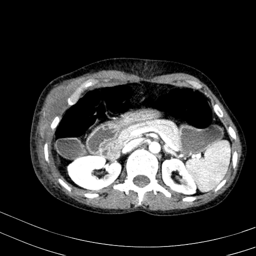 File:Abdominal wall hematoma with active bleeding (Radiopaedia 83915-99117 Axial renal cortical phase 12).jpg