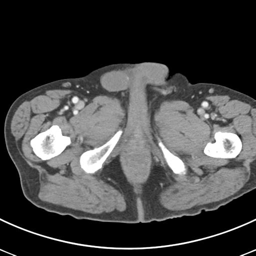 Abdominal wall metastasis from colorectal carcinoma (Radiopaedia 31016-31717 Axial C+ portal venous phase 84).jpg