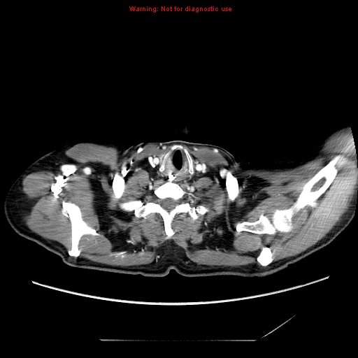 Aberrant right subclavian artery (Radiopaedia 9379-10071 Axial C+ arterial phase 1).jpg