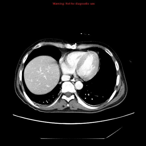File:Aberrant right subclavian artery (Radiopaedia 9379-10071 Axial C+ arterial phase 49).jpg