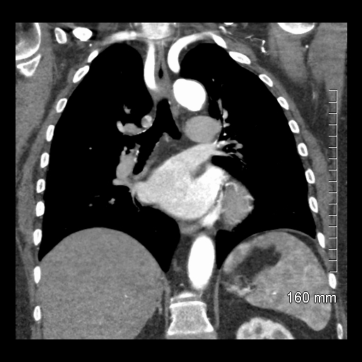 Aberrant right subclavian artery stenosis (Radiopaedia 52656-58670 B 52).jpg