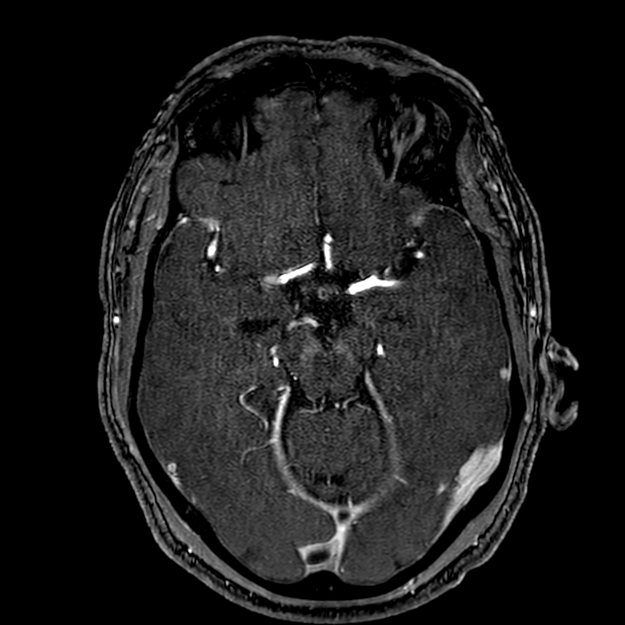Accessory middle cerebral artery (Radiopaedia 73114-83828 Axial MRA 74).jpg