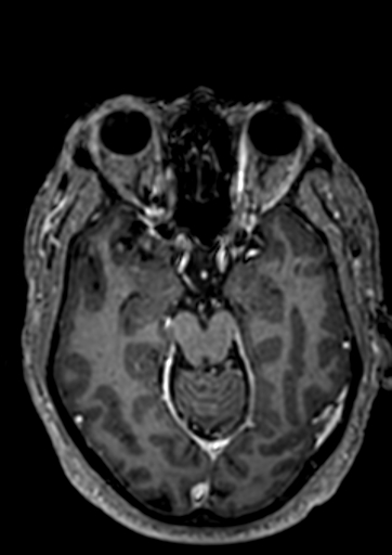 Accessory middle cerebral artery (Radiopaedia 73114-83828 Axial T1 C+ 82).jpg