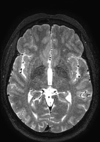 Accessory middle cerebral artery (Radiopaedia 73114-83828 Axial T2 84).jpg