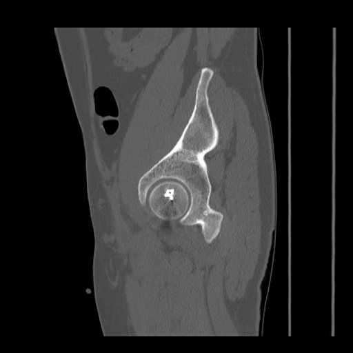 File:Acetabular and ilial fractures (Radiopaedia 59084-66378 Sagittal bone window 73).jpg
