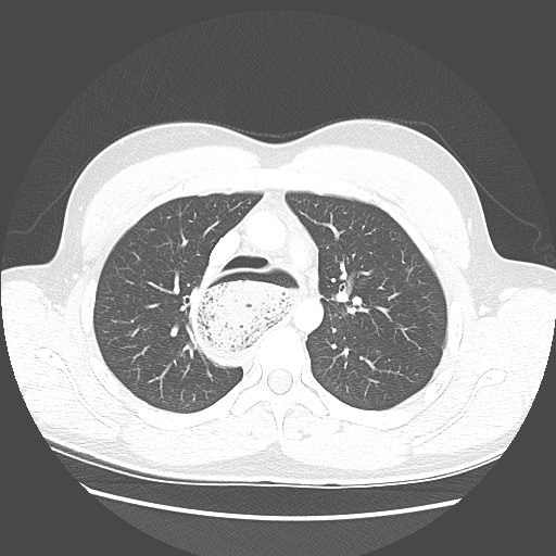 Achalasia (Radiopaedia 52507-58417 Axial lung window 22).jpg