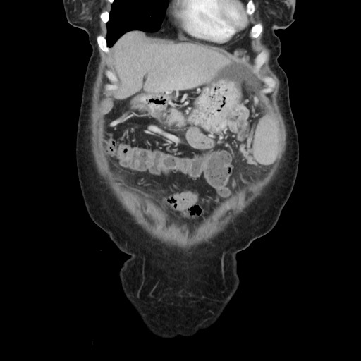 Acinar cell carcinoma of the pancreas (Radiopaedia 75442-86669 Coronal C+ portal venous phase 25).jpg
