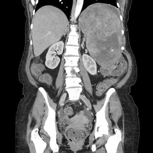 Acinar cell carcinoma of the pancreas (Radiopaedia 75442-86669 Coronal C+ portal venous phase 81).jpg