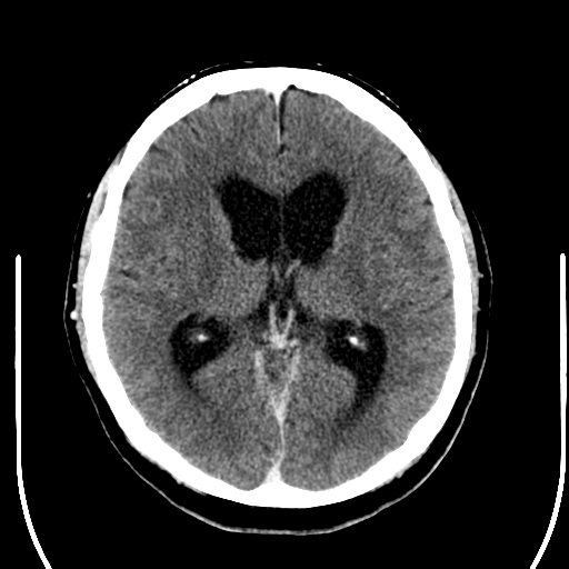 File:Acoustic schwannoma (Radiopaedia 39170-41389 Axial C+ 15).png