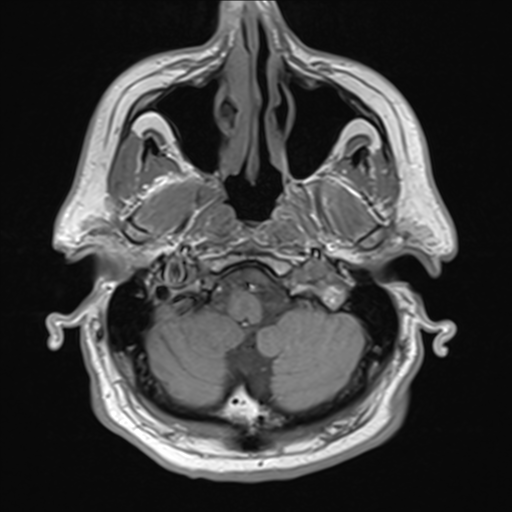File:Acoustic schwannoma (Radiopaedia 55729-62281 T1 1).png