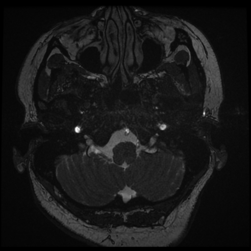 Acoustic schwannoma (Radiopaedia 57574-64536 Axial T2 4).png