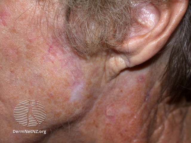 File:Actinic Keratoses treated with imiquimod (DermNet NZ lesions-ak-imiquimod-3730).jpg