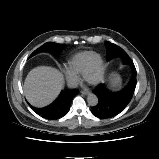 Active colonic bleed on CT (Radiopaedia 49765-55025 Axial non-contrast 1).jpg