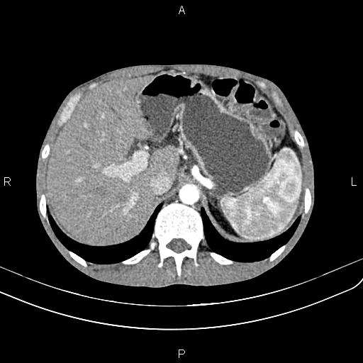 Active crohn disease (Radiopaedia 87133-103397 Axial C+ arterial phase 26).jpg