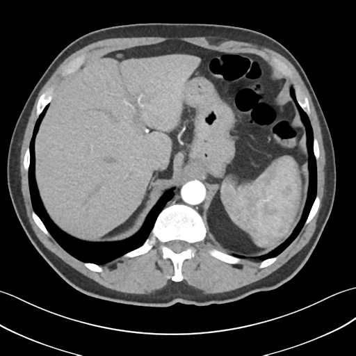 File:Active diverticular hemorrhage (Radiopaedia 39415-41725 Axial C+ arterial phase 12).png