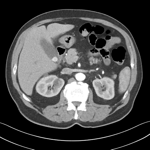 File:Active diverticular hemorrhage (Radiopaedia 39415-41725 Axial C+ arterial phase 21).png
