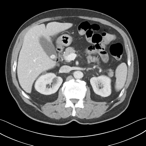 File:Active diverticular hemorrhage (Radiopaedia 39415-41725 Axial C+ portal venous phase 21).png
